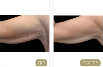 antitsellyulitnye sredstva kak ispolzovat dlya korrektsii figury 1