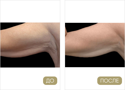 antitsellyulitnye sredstva kak ispolzovat dlya korrektsii figury 1