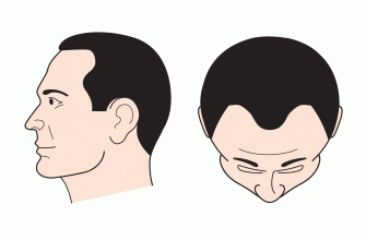 chto delat esli volosy vypadayut