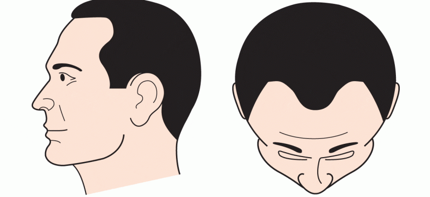 chto delat esli volosy vypadayut