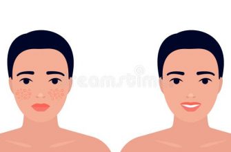 uhod za litsom kak izbavitsya ot pokrasneniy